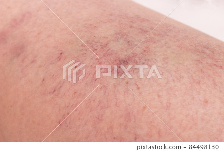 Footprint on the skin from vascular dilatation of veins, vascular pattern on human skin, close-up, phlebeurysm, capillaries, medical 84498130