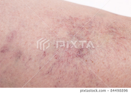 Footprint on the skin from vascular dilatation of veins, vascular pattern on human skin, close-up, phlebeurysm, capillaries 84498896