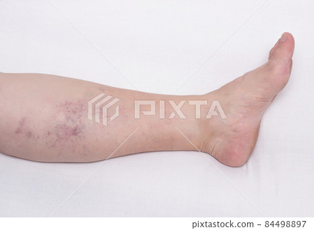Varicose veins on a woman's leg, white background, vascular pattern from varicose veins on the calf of the leg, phlebeurysm 84498897