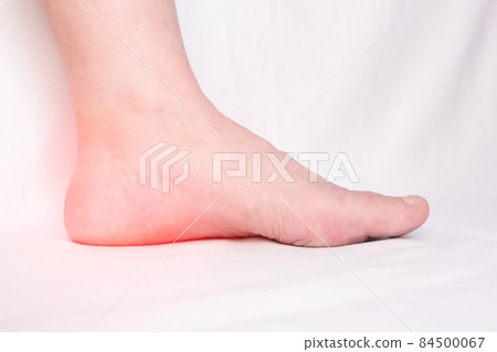 Female leg with a sore heel with a heel spur, spike and osteoite in the heel, pain, close-up, white background, copy space Female leg with a sore heel with a heel spur, spike and osteoite in the heel, pain, close-up, white background, copy space 84500067