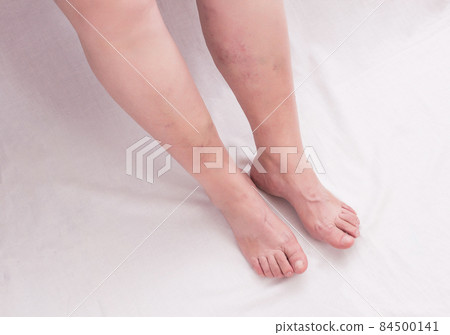 Legs of an old woman on a white background with varicose veins on the legs, phlebeurysm, anatomy Legs of an old woman on a white background with varicose veins on the legs, phlebeurysm, anatomy 84500141