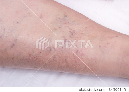 Vascular marks on the skin from varicose veins, vascular pattern on the skin, close-up, phlebeurysm, problem, white background, medical 84500143