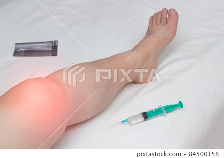 The inflamed leg of a woman with an affected knee joint from arthrosis and arthritis lies next to a syringe with Gilauri acid and a Honndroprotector The inflamed leg of a woman with an affected knee joint from arthrosis and arthritis lies next to a syringe with Gilauri acid and a Honndroprotector 84500158