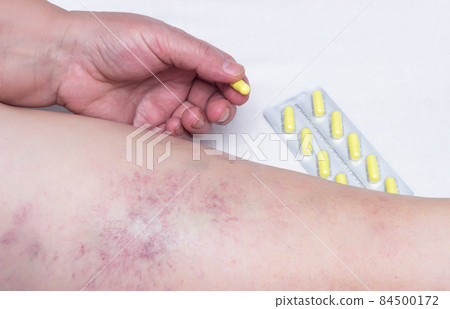 Woman holding a pill for varicose veins on the background of the leg with varicose veins and thrombophlebitis, close-up 84500172