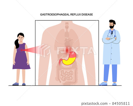 Gastroesophageal reflux disease Gastroesophageal reflux disease 84505811
