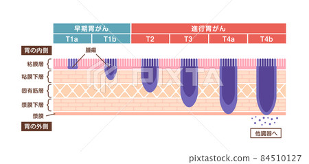 Cross-section illustration of gastric wall / Symptoms and severity stage of gastric cancer / gastric cancer 84510127