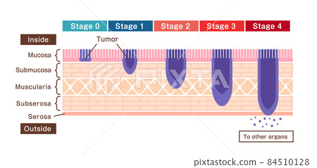 Cross-section illustration of gastric wall / Symptoms and severity stage of gastric cancer / gastric cancer (English) 84510128