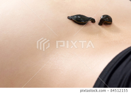 medical leeches on a human body drink blood. Treatment with leeches 84512155