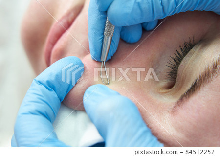 woman uses acne removal stick to remove whitehead pimples on face by squeezing on pimples bump, oily greasy face woman uses acne removal stick to remove whitehead pimples on face by squeezing on pimples bump, oily greasy face 84512252