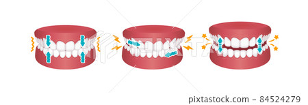 磨牙症 (bruxism) 的類型矢量圖(無文字) 磨牙症 (bruxism) 的類型矢量圖(無文字) 84524279
