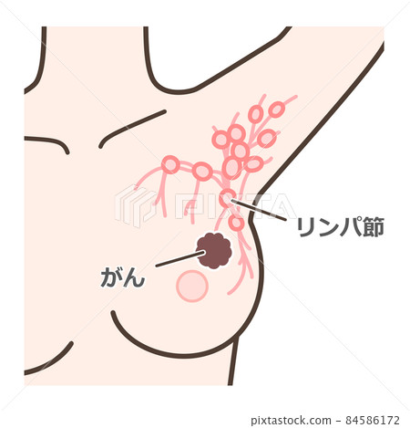 前哨淋巴結活檢評論插圖 84586172