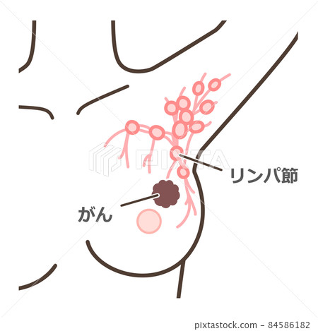 Sentinel lymph node biopsy commentary illustration 84586182