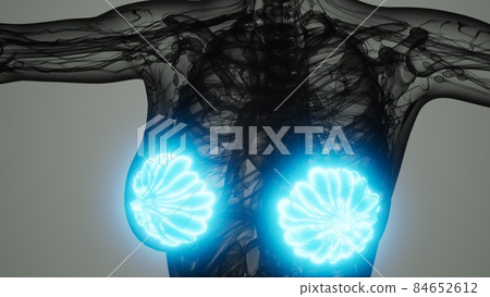 medical scan of Woman Breast Cancer 84652612