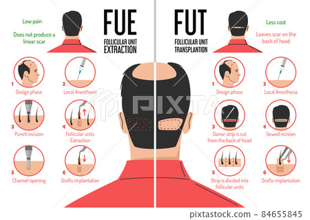 FUT and FUE hair transplantation process isolated 84655845