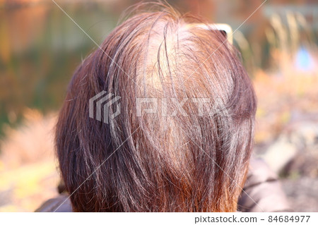 頭髮稀疏的女性，頭髮稀少 84684977