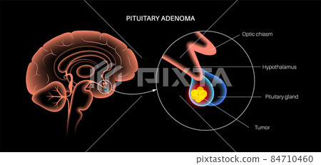 Pituitary adenoma cancer 84710460