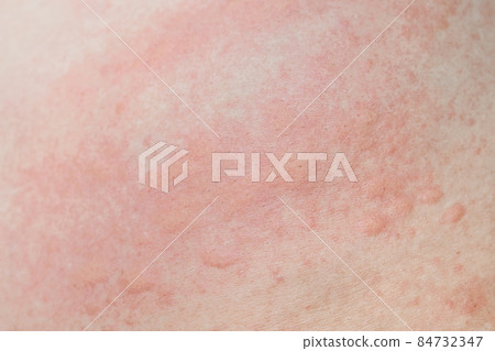 Allergic skin rash prickly heat skin red dot closeup skin problem itching Allergic skin rash prickly heat skin red dot closeup skin problem itching 84732347