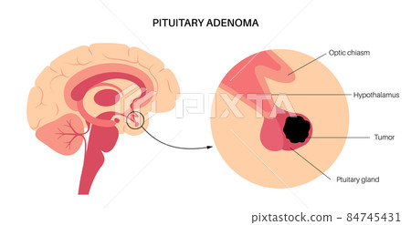 Pituitary adenoma cancer Pituitary adenoma cancer 84745431