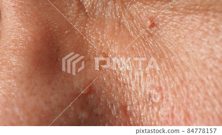 Wart on face. Macro shot of wart near eye. Papilloma on skin around eye nose and neck. Close up of birthmark Papilla or mole on skin. small hard. benign growth on the skin. caused by virus. skincare. Wart on face. Macro shot of wart near eye. Papilloma on skin around eye nose and neck. Close up of birthmark Papilla or mole on skin. small hard. benign growth on the skin. caused by virus. skincare. 84778157
