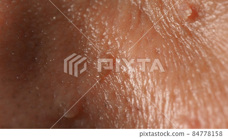 Wart on face. Macro shot of wart near eye. Papilloma on skin around eye nose and neck. Close up of birthmark Papilla or mole on skin. small hard. benign growth on the skin. caused by virus. skincare. Wart on face. Macro shot of wart near eye. Papilloma on skin around eye nose and neck. Close up of birthmark Papilla or mole on skin. small hard. benign growth on the skin. caused by virus. skincare. 84778158