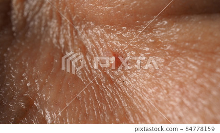 Wart on face. Macro shot of wart near eye. Papilloma on skin around eye nose and neck. Close up of birthmark Papilla or mole on skin. small hard. benign growth on the skin. caused by virus. skincare. Wart on face. Macro shot of wart near eye. Papilloma on skin around eye nose and neck. Close up of birthmark Papilla or mole on skin. small hard. benign growth on the skin. caused by virus. skincare. 84778159