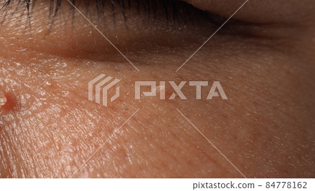 Wart on face. Macro shot of wart near eye. Papilloma on skin around eye nose and neck. Close up of birthmark Papilla or mole on skin. small hard. benign growth on the skin. caused by virus. skincare. Wart on face. Macro shot of wart near eye. Papilloma on skin around eye nose and neck. Close up of birthmark Papilla or mole on skin. small hard. benign growth on the skin. caused by virus. skincare. 84778162