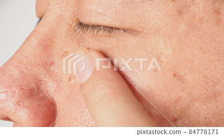 Wart on face. Macro shot of wart near eye. Papilloma on skin around eye nose and neck. Close up of birthmark Papilla or mole on skin. small hard. benign growth on the skin. caused by virus. skincare. 84778171
