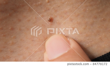 Wart on face. Macro shot of wart near eye. Papilloma on skin around eye nose and neck. Close up of birthmark Papilla or mole on skin. small hard. benign growth on the skin. caused by virus. skincare. Wart on face. Macro shot of wart near eye. Papilloma on skin around eye nose and neck. Close up of birthmark Papilla or mole on skin. small hard. benign growth on the skin. caused by virus. skincare. 84778172
