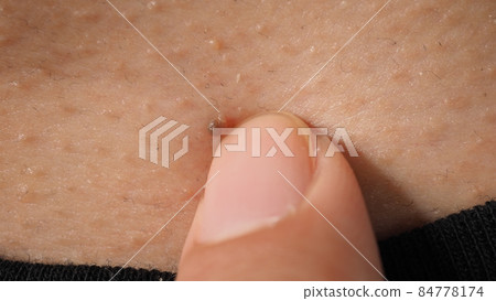 Wart on face. Macro shot of wart near eye. Papilloma on skin around eye nose and neck. Close up of birthmark Papilla or mole on skin. small hard. benign growth on the skin. caused by virus. skincare. 84778174