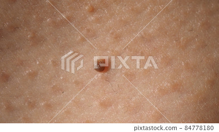 Wart on face. Macro shot of wart near eye. Papilloma on skin around eye nose and neck. Close up of birthmark Papilla or mole on skin. small hard. benign growth on the skin. caused by virus. skincare. Wart on face. Macro shot of wart near eye. Papilloma on skin around eye nose and neck. Close up of birthmark Papilla or mole on skin. small hard. benign growth on the skin. caused by virus. skincare. 84778180