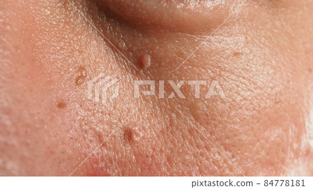 Wart on face. Macro shot of wart near eye. Papilloma on skin around eye nose and neck. Close up of birthmark Papilla or mole on skin. small hard. benign growth on the skin. caused by virus. skincare. 84778181