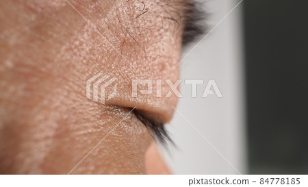 Wart on face. Macro shot of wart near eye. Papilloma on skin around eye nose and neck. Close up of birthmark Papilla or mole on skin. small hard. benign growth on the skin. caused by virus. skincare. Wart on face. Macro shot of wart near eye. Papilloma on skin around eye nose and neck. Close up of birthmark Papilla or mole on skin. small hard. benign growth on the skin. caused by virus. skincare. 84778185