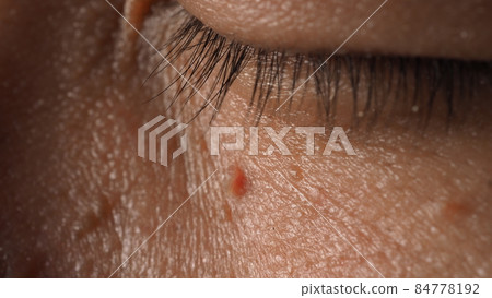 Wart on face. Macro shot of wart near eye. Papilloma on skin around eye nose and neck. Close up of birthmark Papilla or mole on skin. small hard. benign growth on the skin. caused by virus. skincare. Wart on face. Macro shot of wart near eye. Papilloma on skin around eye nose and neck. Close up of birthmark Papilla or mole on skin. small hard. benign growth on the skin. caused by virus. skincare. 84778192
