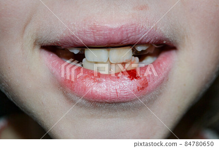 Dry and damaged lips of a girl 84780650