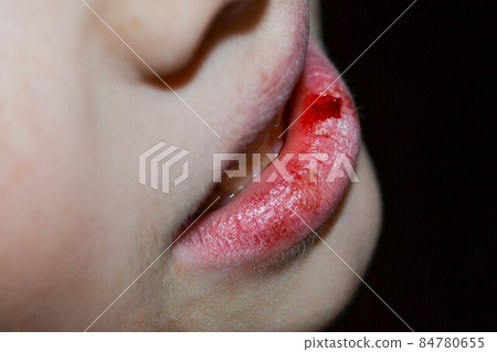 Dry and damaged lips of a girl Dry and damaged lips of a girl 84780655