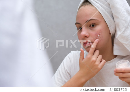 teenage girl . Acne. Care for problem skin 84803723