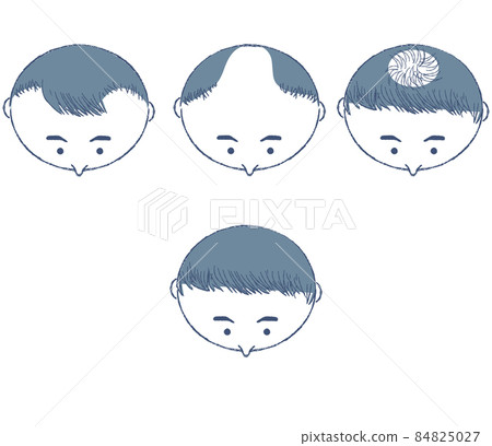 頭髮稀疏類型列表和治療後改善 84825027