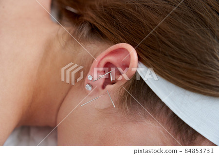 Beautiful woman relaxing on a bed having acupuncture treatment with needles in and around her ear. Alternative Therapy concept 84853731