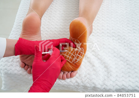 The doctor makes intramuscular injections of botulinum toxinon in female feet against hyperhidrosis, excessive sweating 84853751