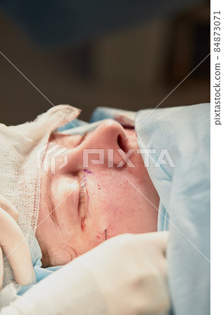 Close up of the face of a patient who is undergoing blepharoplasty. The surgeon cuts the eyelid and performs manipulations using medical instruments Close up of the face of a patient who is undergoing blepharoplasty. The surgeon cuts the eyelid and performs manipulations using medical instruments 84873071