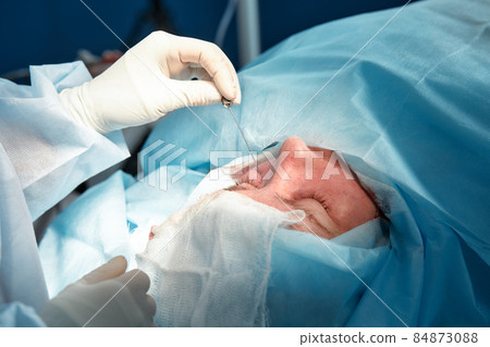 Close up of the face of a patient who is undergoing blepharoplasty. The surgeon cuts the eyelid and performs manipulations using medical instruments 84873088