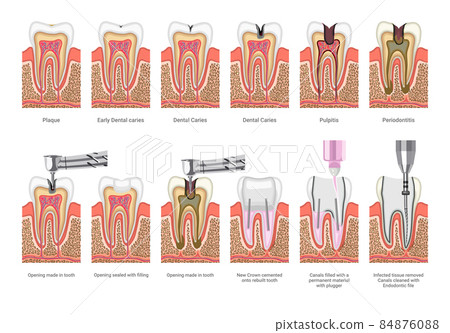 Dental Caries and Treatment Illustrations Dental Caries and Treatment Illustrations 84876088