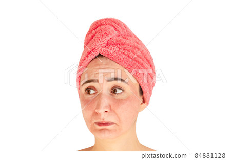 Face with skin irritation, acne, rash or sunburn Face with skin irritation, acne, rash or sunburn 84881128