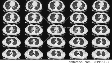 Computed tomography of the lungs in a healthy adult man. Normal lungs ct scan. May be part of COVID-19 diagnostic. 84943127