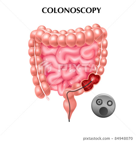 Colonoscopy Realistic Poster 84948070