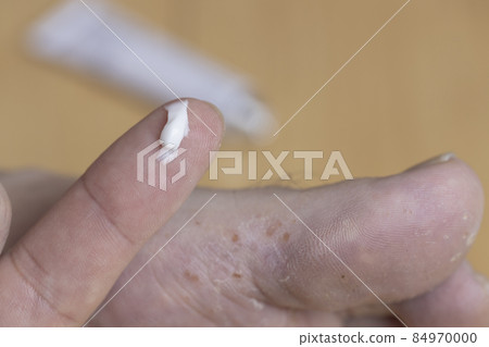腳氣和腳底軟膏 84970000