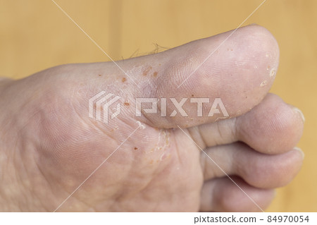 運動員的腳 運動員的腳 84970054