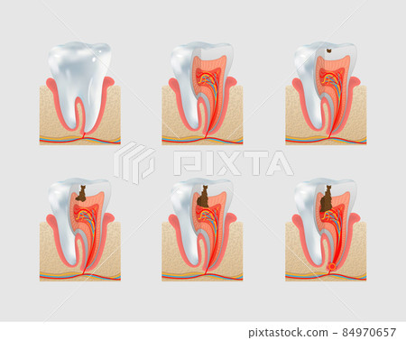 Vector healthy tooth and dental caries icon set - Stock Illustration ...