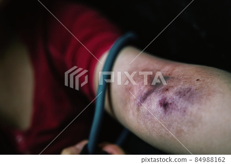Woman's arm is bruised from taking intravenous narcotic. Drug addict pulls tourniquet on arm. Large blood hematoma close-up. Concept of addiction to banned substances and depression. Woman's arm is bruised from taking intravenous narcotic. Drug addict pulls tourniquet on arm. Large blood hematoma close-up. Concept of addiction to banned substances and depression. 84988162