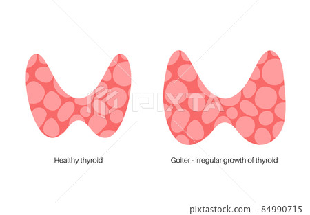 thyroid gland disease thyroid gland disease 84990715